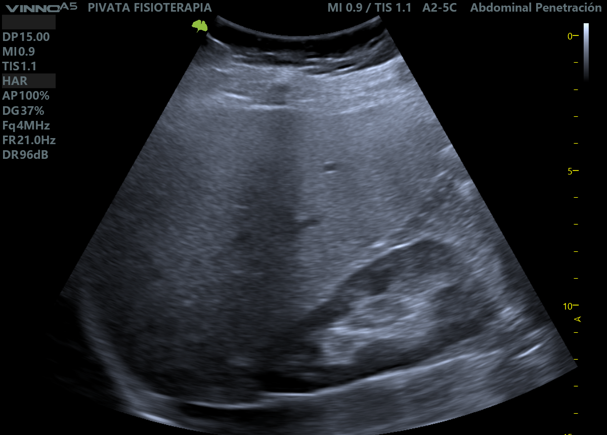 Ultrasonido abdominal