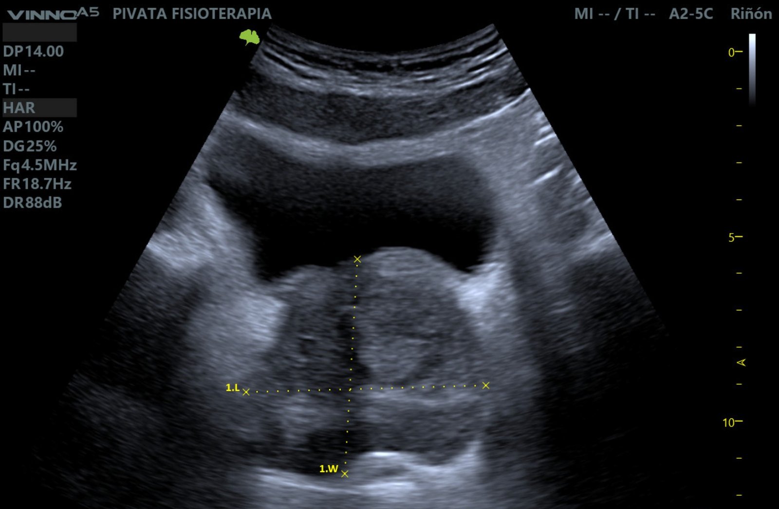 Ultrasonido de próstata