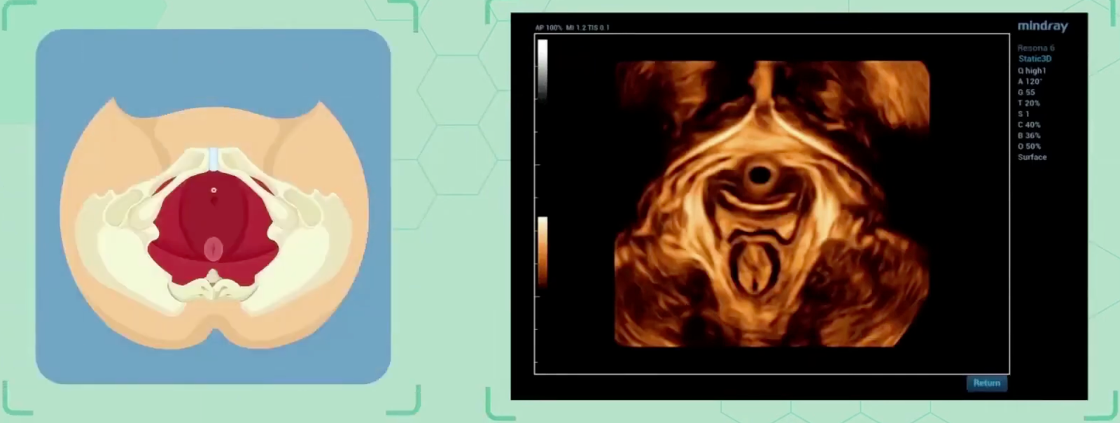 Ultrasonido de piso pélvico